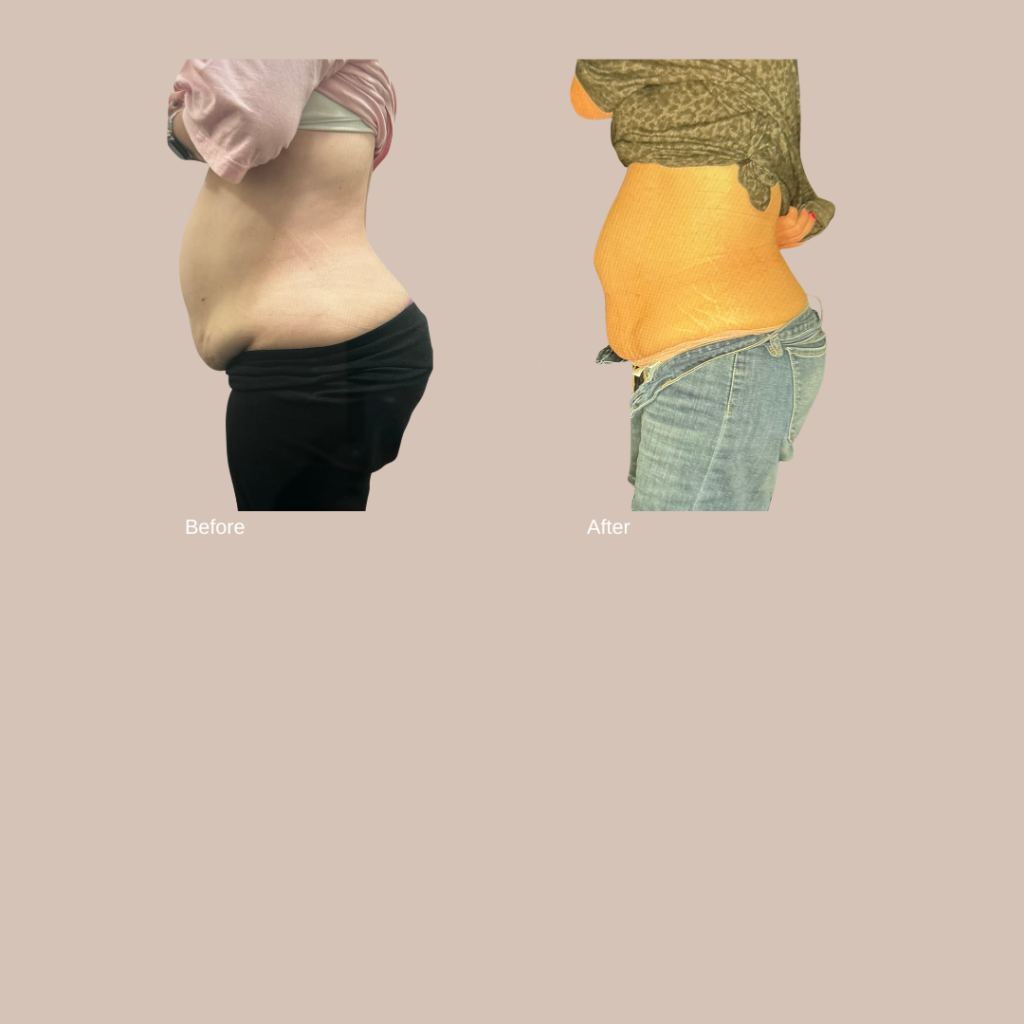 Icoone Combined Treatment - Frisco Body Contouring and Weight Loss